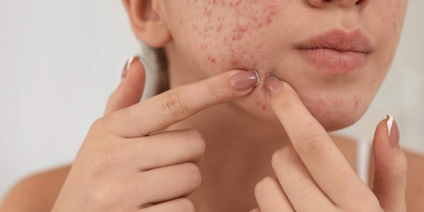 Assunzione di proteine e acne: esiste una correlazione?