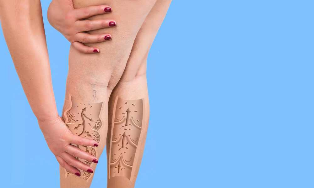 Lymphaselect: studi clinici sul nuovo ingrediente per migliorare il microcircolo